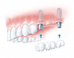 dental implants near me harrow